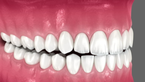 How to Compare Dental Implant Providers Before Making a Decision